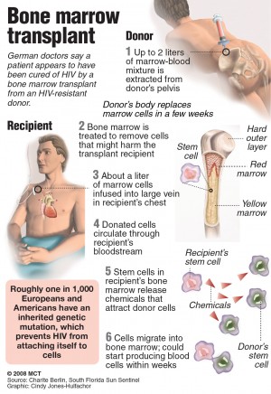 Graphic illustrates how a bone marrow transplant is performed; German doctors say a patient appears to have been cured of HIV by a bone marrow transplant from an HIV-resistant donor. South Florida Sun Sentinel 2008